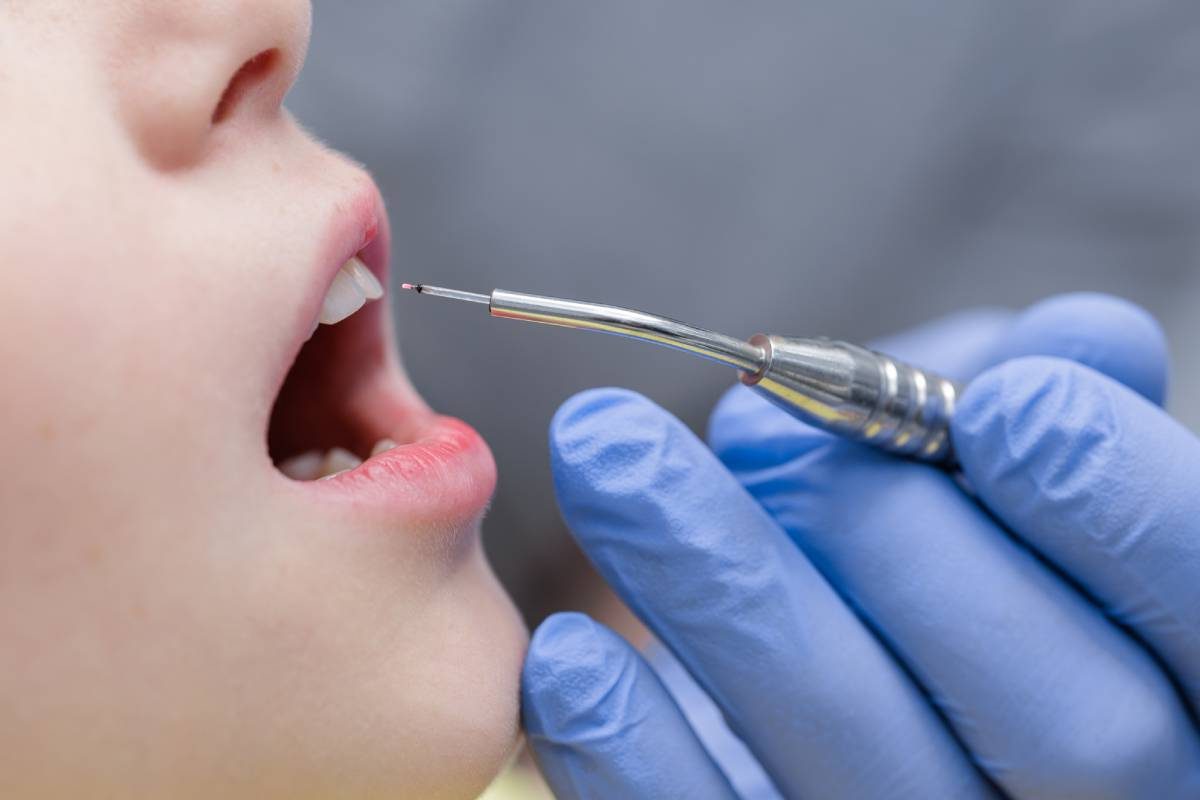 Laserzahnmedizin beim Zahnerhalt – präzise Behandlung am Zahn in Delmenhorst